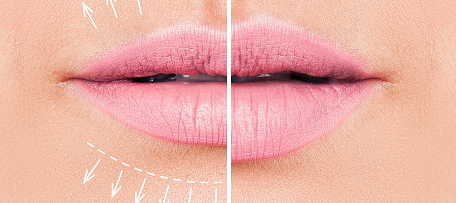 Before and after lip filler - model stock photo