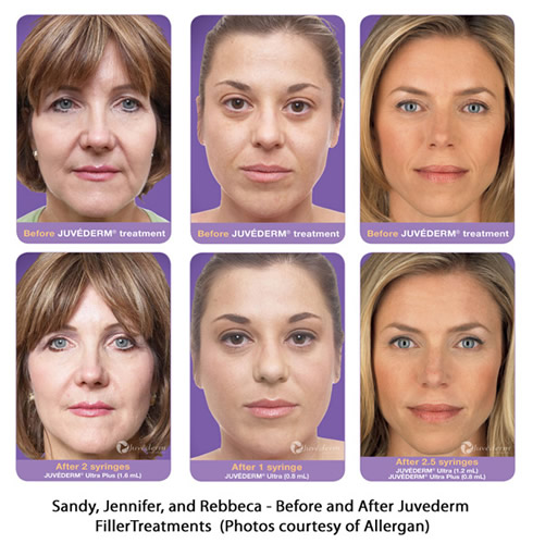 Before and After photos of Juvederm patients (photos courtesy of Allergan)